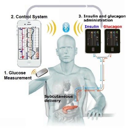 Bionic-Pancreas-System-Graphic